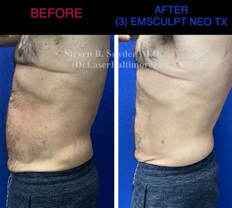 neo emsculpt oakdale|Emsculpt Neo Overview: Cost, Recovery, Before & After .